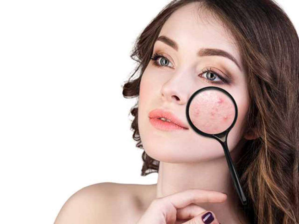 How to prevent acne from recurring? 
