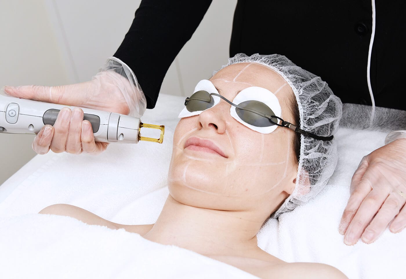 Advantages of Laser Treatments for Pigmentation Removal