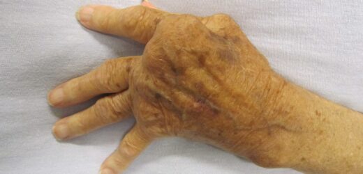 Why Is Rheumatoid Arthritis More Common in Females